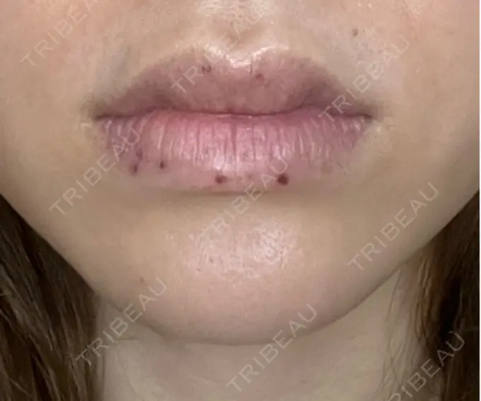 シミ取りレーザー / その他（口元） Wクリニック 梅田院 DAY 5 メイン用