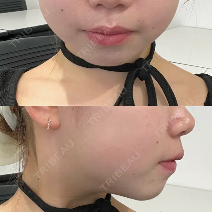 RF（高周波）たるみ治療 大美会クリニック 梅田院 DAY 22 メイン用