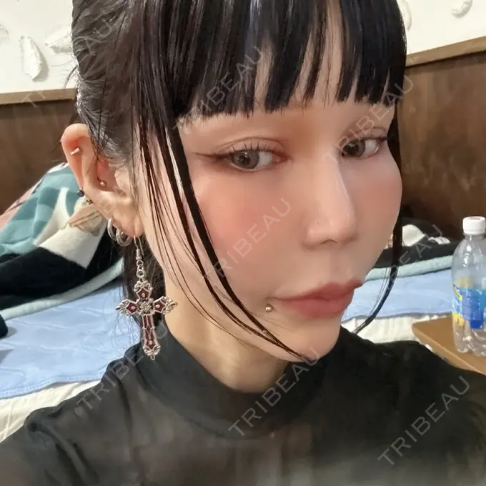 小鼻縮小（非切開） 形成外科と美容外科のクリニック池袋 DAY 5 メイン用