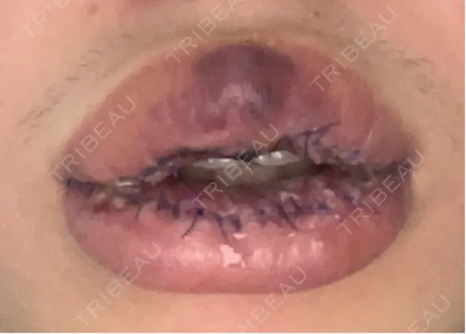 口唇縮小術 高須クリニック 大阪院 DAY 3 メイン用