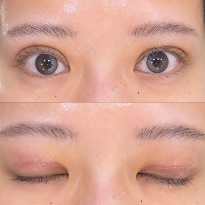 二重切開 / 眼瞼下垂（切開） eクリニック 新宿院 DAY 10 メイン用