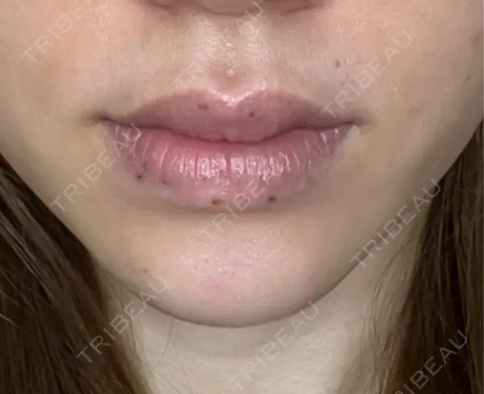 シミ取りレーザー / その他（口元） Wクリニック 梅田院 DAY 6 メイン用