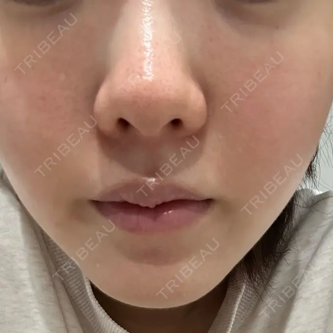 肌育注射（ジュベルックなど） 城本クリニック 池袋院 DAY 10 メイン用