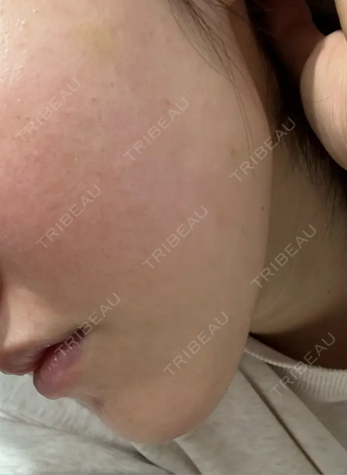 肌育注射（ジュベルックなど） 城本クリニック 池袋院 DAY 10 メイン用