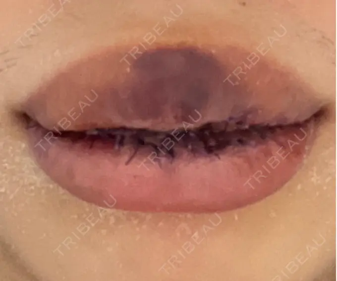 口唇縮小術 高須クリニック 大阪院 DAY 4 メイン用