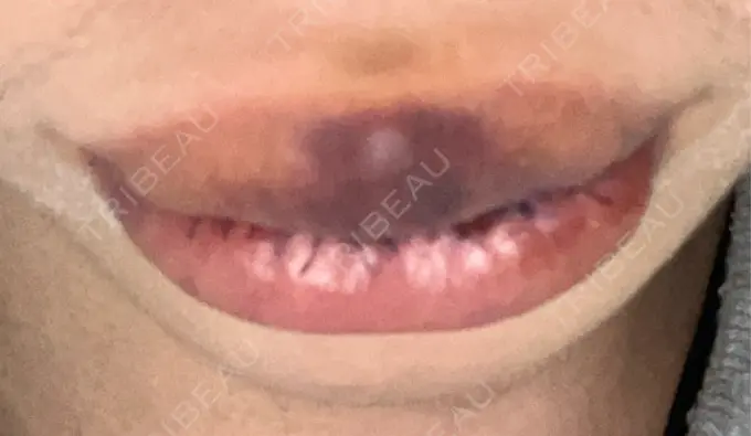 口唇縮小術 高須クリニック 大阪院 DAY 4 メイン用
