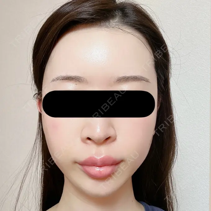 糸リフト / バッカルファット除去 / 脂肪吸引（顔） / ジョールファット除去 / ヒアルロン酸注入（額） / ヒアルロン酸注入（頬） BLINC CLINIC （ブリンク クリニック） AFTER メイン用