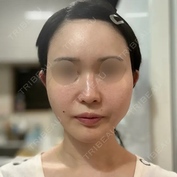 RF（高周波）たるみ治療 Chloe Cheongdam Clinic （クロエチョンダムクリニック） AFTER メイン用