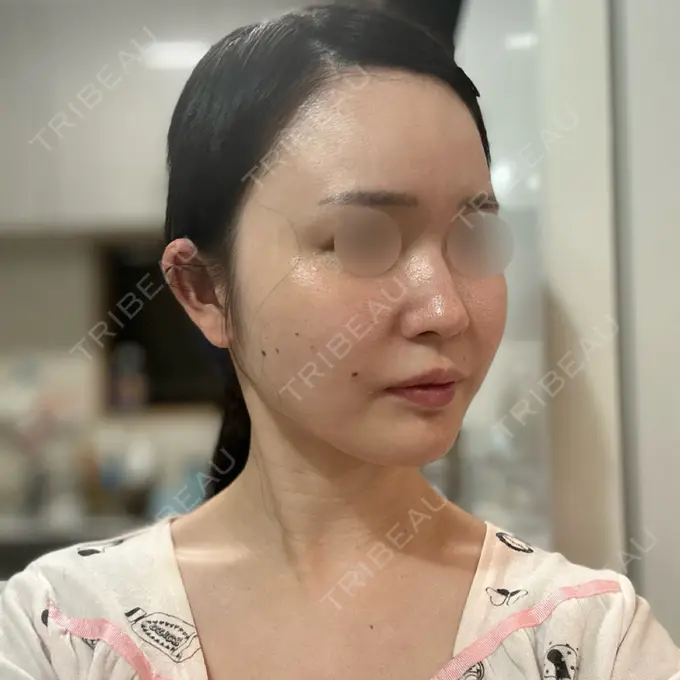 RF（高周波）たるみ治療 Chloe Cheongdam Clinic （クロエチョンダムクリニック） DAY 28 メイン用