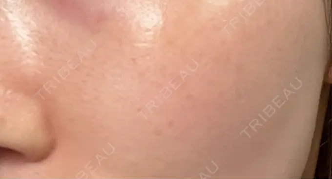 イオン導入 / ルメッカ ルラ美容クリニック 上野院 AFTER メイン用