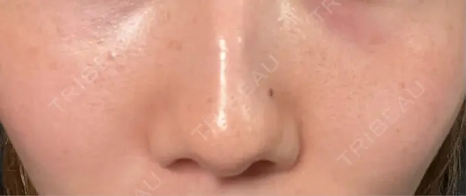 イオン導入 / ルメッカ ルラ美容クリニック 上野院 DAY 8 メイン用