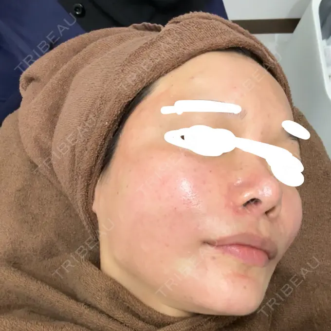 肌育注射（ジュベルックなど） / その他（肌） ゆきスキンクリニック 東池袋 DAY 0 メイン用