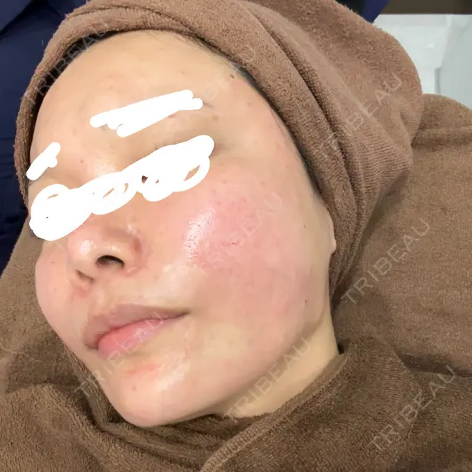 肌育注射（ジュベルックなど） / その他（肌） ゆきスキンクリニック 東池袋 DAY 0 メイン用