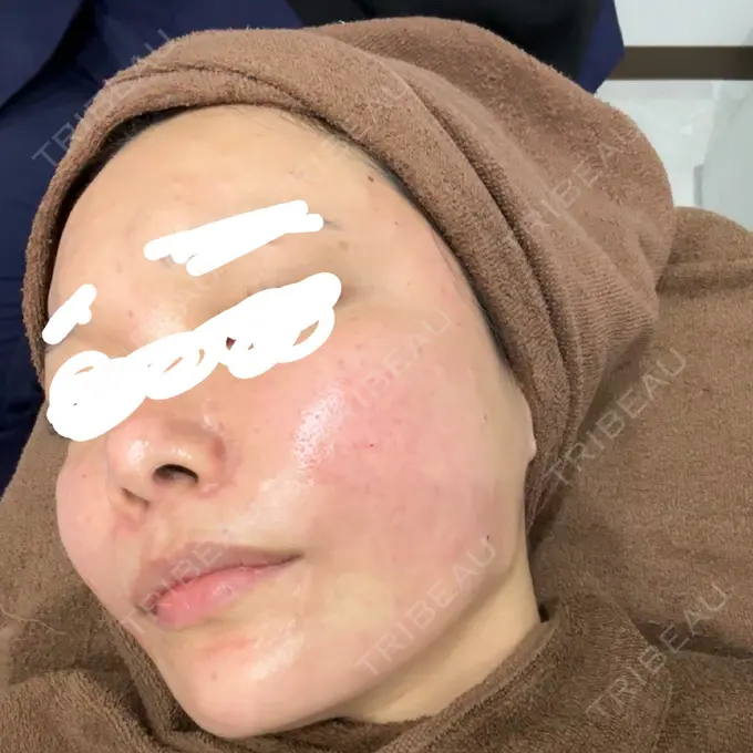 肌育注射（ジュベルックなど） / その他（肌） ゆきスキンクリニック 東池袋 DAY 0 メイン用