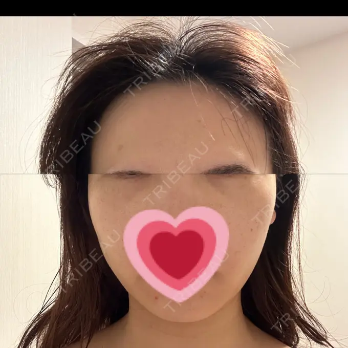 RF（高周波）たるみ治療 タイムルクリニック DAY 2 メイン用