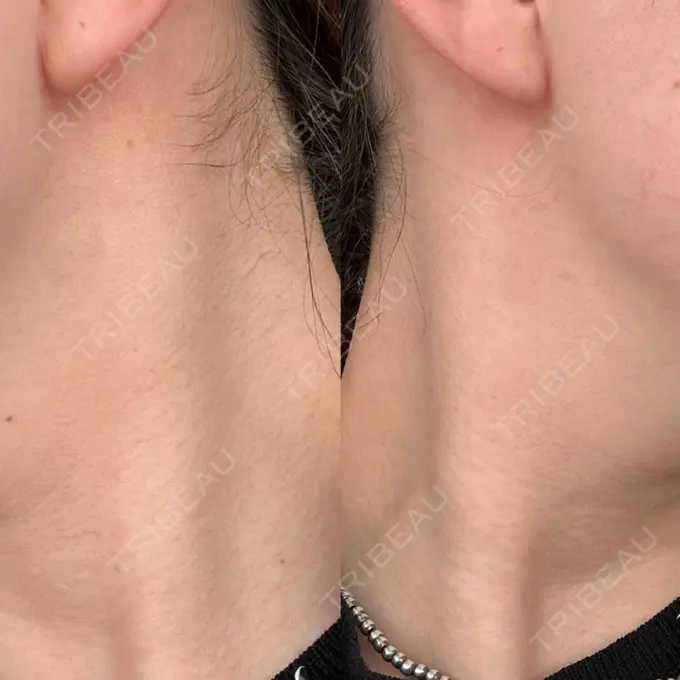 ボトックス（エラ・小顔） Natural Skin Clinic 自由ヶ丘院 DAY 0 メイン用