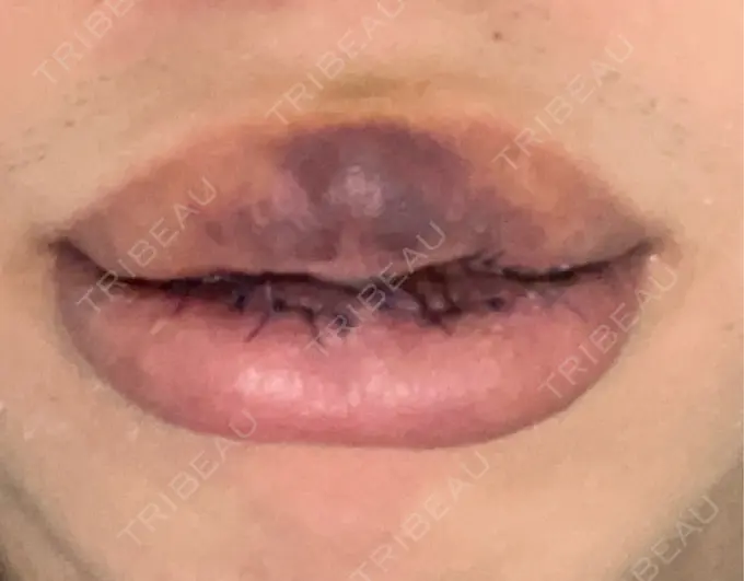 口唇縮小術 高須クリニック 大阪院 DAY 5 メイン用