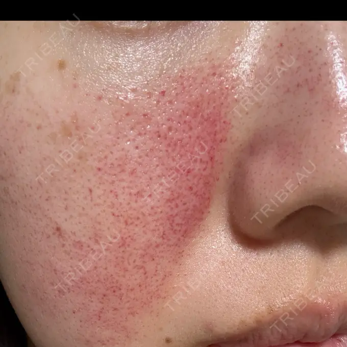 ピコレーザートーニング（美白・肝斑） / ピコフラクショナルレーザー（毛穴・ニキビ跡） APスキンクリニック銀座 DAY 0 メイン用