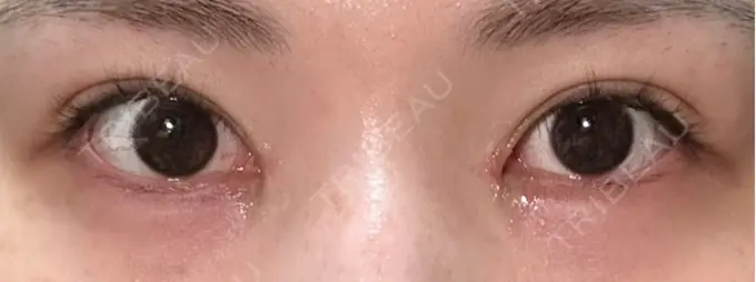 二重埋没 / 目頭切開 / その他（目元） eクリニック 福岡院 AFTER メイン用