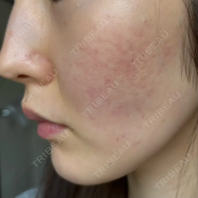 ピーリング（ハリ・ツヤ） / ルメッカ ルラ美容クリニック 静岡院 DAY 1 メイン用