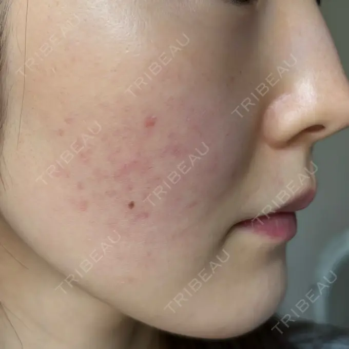 ピーリング（ハリ・ツヤ） / ルメッカ ルラ美容クリニック 静岡院 DAY 1 メイン用