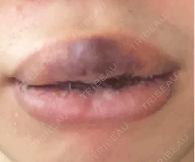 口唇縮小術 高須クリニック 大阪院 DAY 6 メイン用