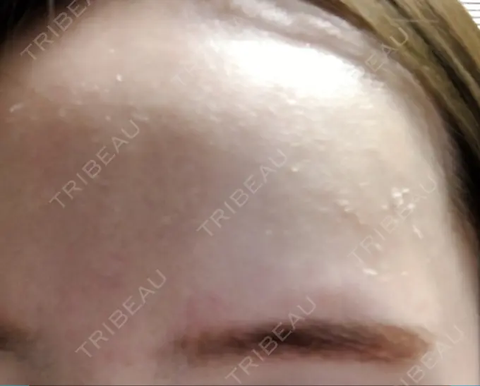 美肌レーザー みやた形成外科・皮ふクリニック DAY 11 メイン用