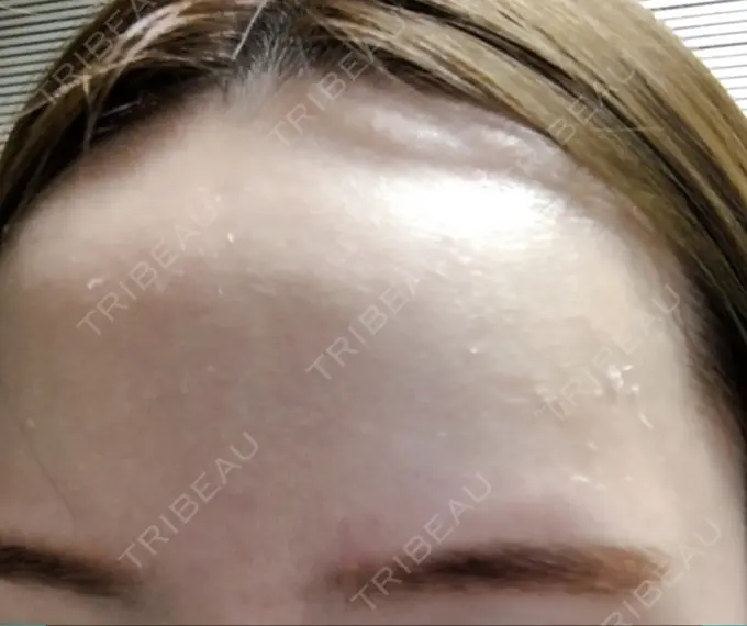 美肌レーザー みやた形成外科・皮ふクリニック DAY 11 メイン用