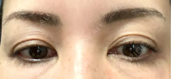 アートメイク（眉） REDLINE CLINIC DAY 3 メイン用