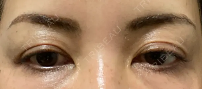 アートメイク（眉） REDLINE CLINIC DAY 4 メイン用