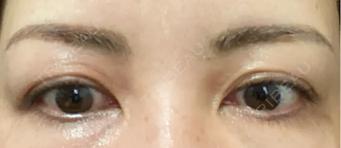 アートメイク（眉） REDLINE CLINIC DAY 5 メイン用