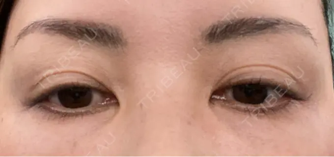 アートメイク（眉） REDLINE CLINIC DAY 6 メイン用