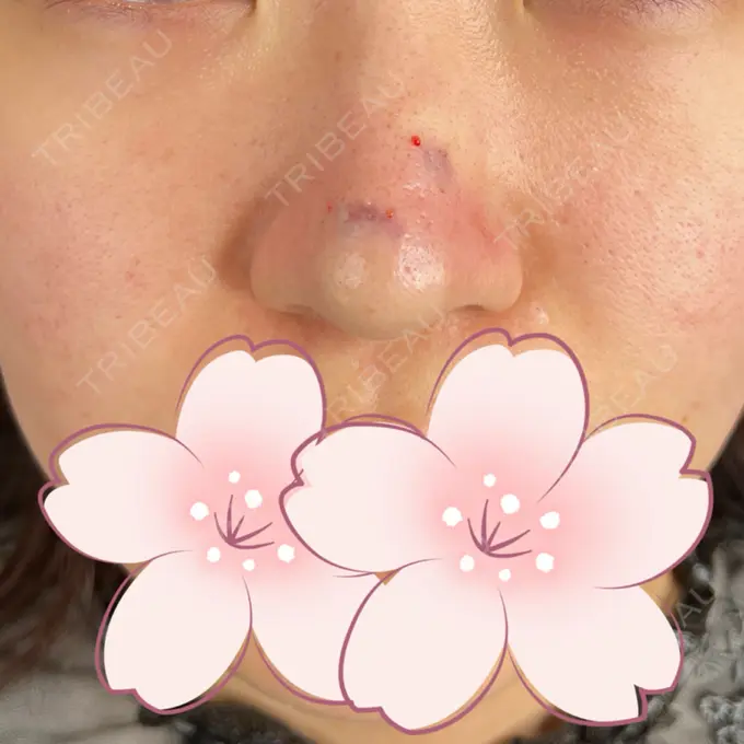 ボトックス（あご） / ボトックス（エラ・小顔） / ボトックス（眉間） / ボトックス（額） / サブシジョン 藤・ナチュレ美容クリニック 銀座院 DAY 0 メイン用