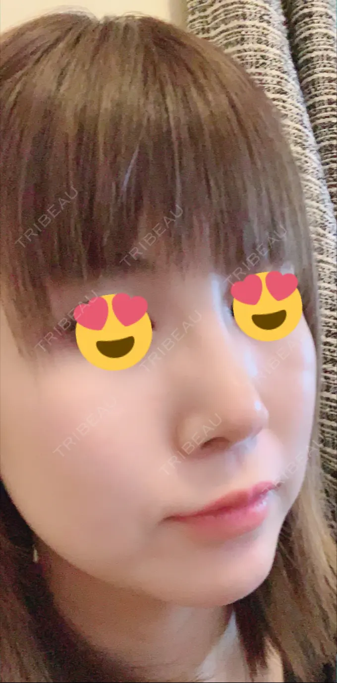 隆鼻術 / 鼻尖形成（切開） / 鼻中隔延長（切開） / 脂肪吸引（顔） / 軟骨移植 / プロテーゼ除去 / ヒアルロン酸注入（唇） ジュエリー美容外科 DAY 41 メイン用