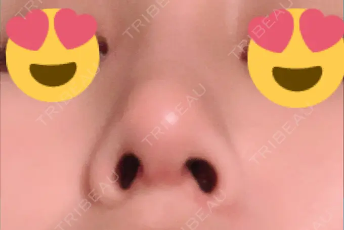 隆鼻術 / 鼻尖形成（切開） / 鼻中隔延長（切開） / 脂肪吸引（顔） / 軟骨移植 / プロテーゼ除去 / ヒアルロン酸注入（唇） ジュエリー美容外科 DAY 41 メイン用