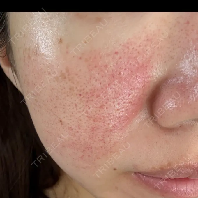 ピコレーザートーニング（美白・肝斑） / ピコフラクショナルレーザー（毛穴・ニキビ跡） APスキンクリニック銀座 DAY 2 メイン用