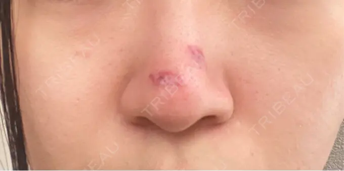 ボトックス（あご） / ボトックス（エラ・小顔） / ボトックス（眉間） / ボトックス（額） / サブシジョン 藤・ナチュレ美容クリニック 銀座院 DAY 1 メイン用