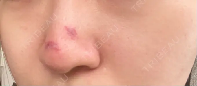 ボトックス（あご） / ボトックス（エラ・小顔） / ボトックス（眉間） / ボトックス（額） / サブシジョン 藤・ナチュレ美容クリニック 銀座院 DAY 1 メイン用