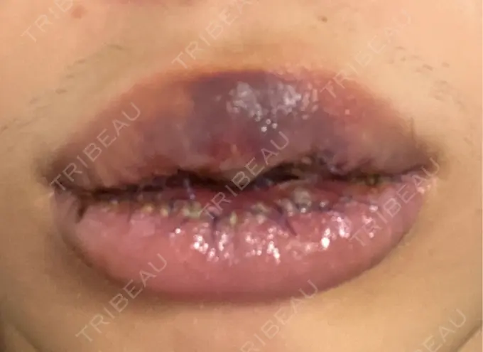 口唇縮小術 高須クリニック 大阪院 DAY 7 メイン用