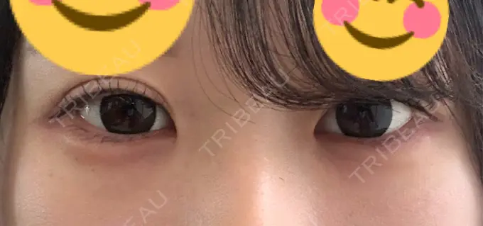 ヒアルロン酸注入（涙袋） フィラークリニック 大阪心斎橋院 DAY 0 メイン用