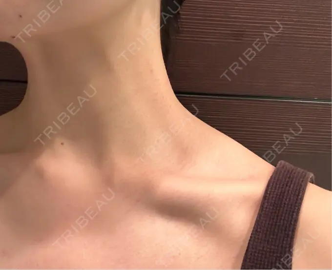 ボトックス（エラ・小顔） / ボトックス（口角） / ボトックス（人中） ルヴィクリニック イオンドーム前院 AFTER メイン用