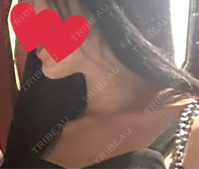 ボトックス（エラ・小顔） / ボトックス（口角） / ボトックス（人中） ルヴィクリニック イオンドーム前院 DAY 18 メイン用