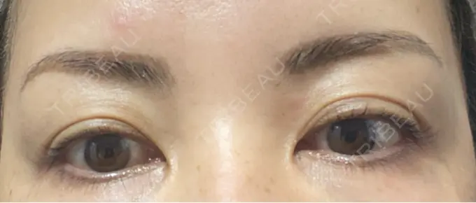 アートメイク（眉） REDLINE CLINIC DAY 7 メイン用