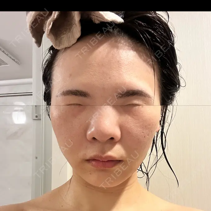 RF（高周波）たるみ治療 タイムルクリニック AFTER メイン用