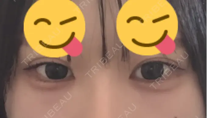 ヒアルロン酸注入（涙袋） フィラークリニック 大阪心斎橋院 DAY 1 メイン用