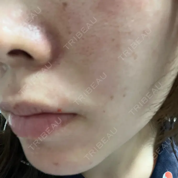 ポテンツァ パルム美容クリニック DAY 0 メイン用