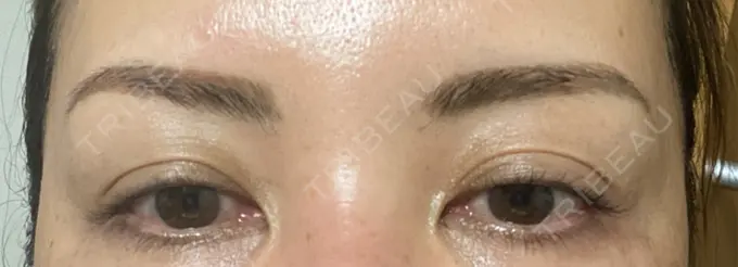 アートメイク（眉） REDLINE CLINIC DAY 8 メイン用