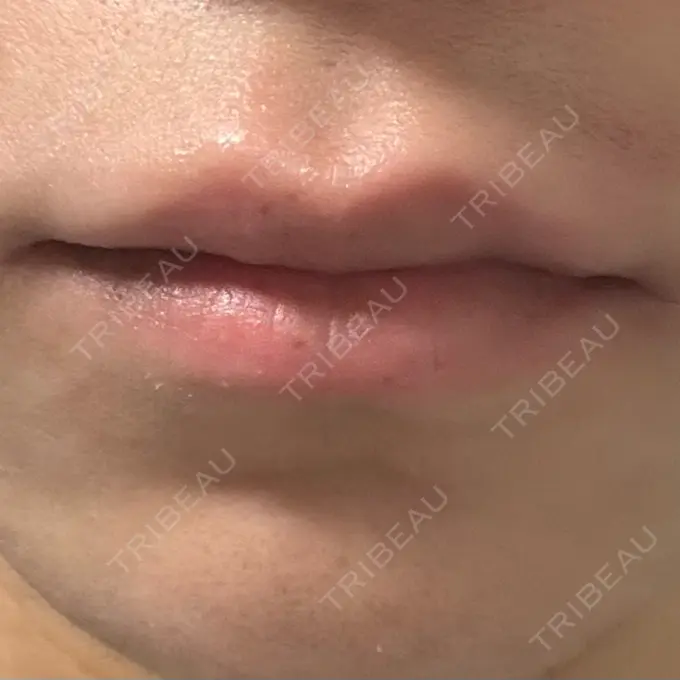 ヒアルロン酸注入（唇） アリエル美容クリニック 横浜院 DAY 1 メイン用