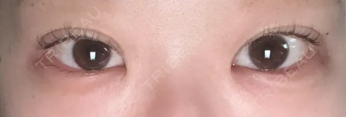 ヒアルロン酸注入（涙袋） フィラークリニック 大阪心斎橋院 AFTER メイン用