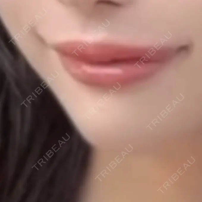 ヒアルロン酸注入（唇） AZ BEAUTY CLINIC AFTER メイン用